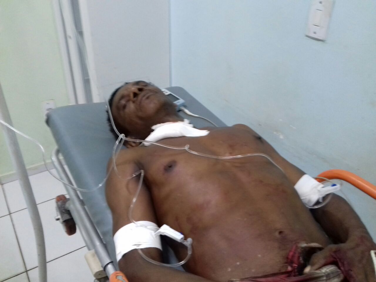 EM CODÓ VITIMA TAZAM LEVA UMA FACADA E VAI PARAR NO HOSPITAL- O MESMO JÁ É UM VELHO CONHECIDO DA POLICIA.