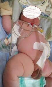 BEBÊ DE 5,7 KG TEM BRAÇOS QUEBRADOS DURANTE PARTO NORMAL EM NOVO PROGRESSO