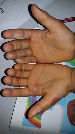 MÃE COLOCA MÃOS DE CRIANÇA EM FOGAREIRO EM CHAMAS E CONSELHO TUTELAR FICA DO LADO DA MÃE ALEGANDO QUE ELA É MUITO POBRE, EM CODÓ! COMO ASSIM CONSELHEIROS??